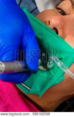 Dentist Treats The Tooth With Modern Methods, Uses A Rubber Dam, Sterile Tooth Treatment.