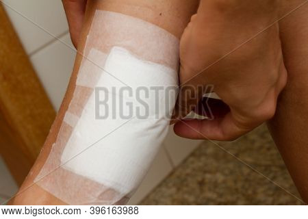 A Woman Applying A Gauze Bandage To A Second Degree Burn On The Back Of Her Leg