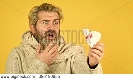 Guy Blow Out Nose In Paper With Blood. Allergic Reaction. Nose Bleed. Against Virus Or Bacteria. Flu