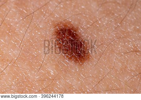 Spot On The Skin
