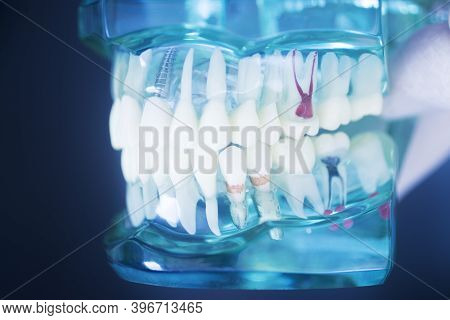 Tooth Decay Dental Model