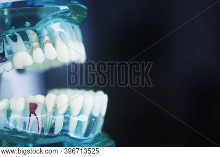 Tooth Decay Dental Model