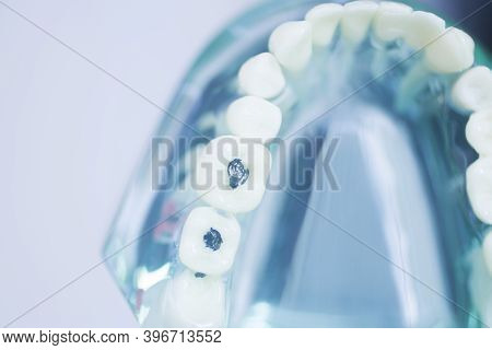 Tooth Decay Dental Model