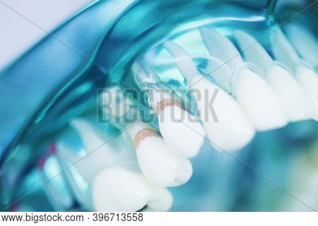 Tooth Decay Dental Model