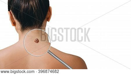 Magnifying Glass Showing Mole On Female Skin. Preventive Examination Of A Nevus On The Human Body