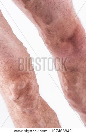 People With Varicose Veins Of The Lower Extremities And Venous Thrombophlebitis And Standing On A Wh