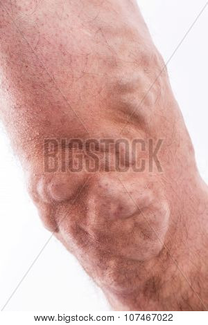 People With Varicose Veins Of The Lower Extremities And Venous Thrombophlebitis And Standing On A Wh