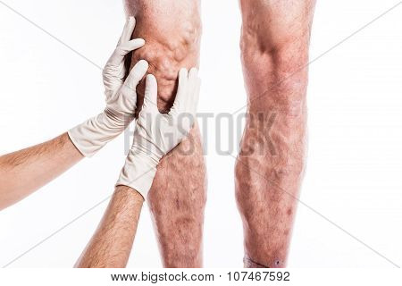 Doctor In Medical Gloves Examines A Person With Varicose Veins Of The Lower Extremities And Venous T