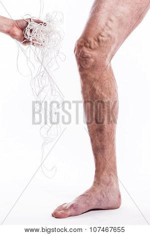 A Tangle Of Ropes With A Man Being Ill With Varicose Veins Of The Lower Extremities And Venous Throm