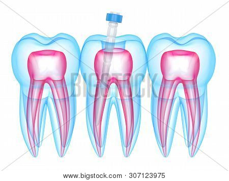 3d Render Of Teeth With Fiber Post Over White Background