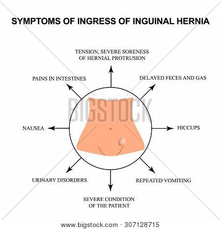 Symptoms Of Impaired Inguinal Hernia. Infographics. Illustration On Isolated Background.