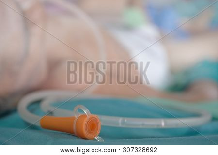 Nasogastric Tube Feeding.insert A Nose To Feed The Patient.
