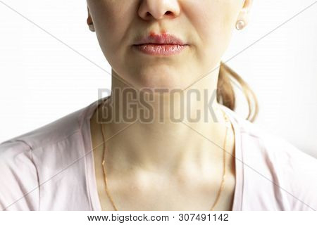 Red Bubbles Of Virus Herpes On Lips Of A Woman In Light Pink T-shirt, Lower Part Face Is Seen. Medic
