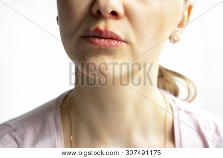 Red Bubbles Of Virus Herpes On Lips Of A Woman In Light Pink T-shirt, Lower Part Face Is Seen. Medic