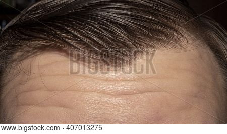 A Man\'s Forehead Is Furrowed.wrinkles On The Forehead Background Photo.the Forehead Is Lined And Cr