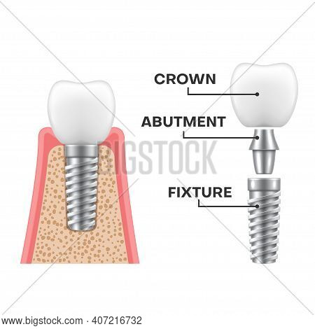 Dental Implant Structure Realistic Schematic. Implantation Sequence. Fixture, Abutment, Crown.