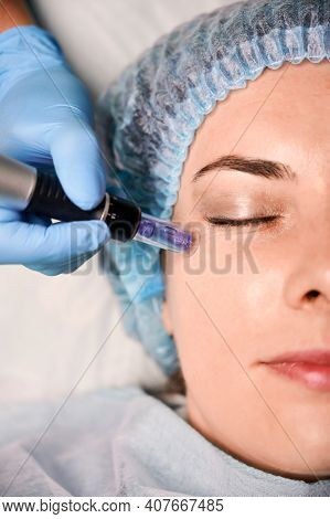 Close Up Of Cosmetologist Hand In Sterile Glove Using Dermapen During Skincare Procedure. Young Woma