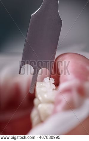 Dental Height Gauge. Macro Photography. Vertical Close-up Snaphot Of A Dental Measuring Tool, Teeth 