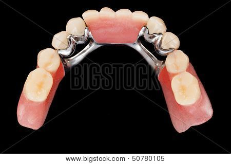 Dental Skeletal Prosthesis - Upper Vew