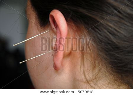 Alternativní terapie: Acupunture