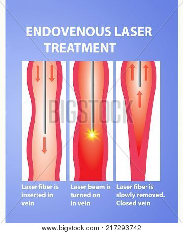Varicose Veins and laser. Endovenous laser treatment