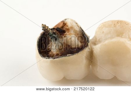 damaged cermet prosthesis with broken parts of teeth