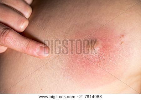 Closeup of an huge skin abcess getting inflamed