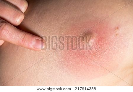 Closeup of an huge skin abcess getting inflamed