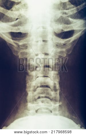 X-ray of human loins or small of the back, vertebra or spine, vertical image