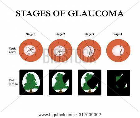 Glaucoma. The Field Of Vision In Glaucoma. Atrophy Of The Optic Nerve. Infographics. Illustration On