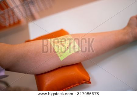 Vein Scanning. Patient Hand With Veins Mapping Close Up