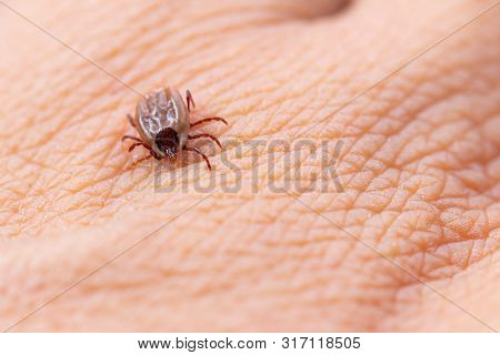 Tick Filled With Blood Sitting On Human Skin.