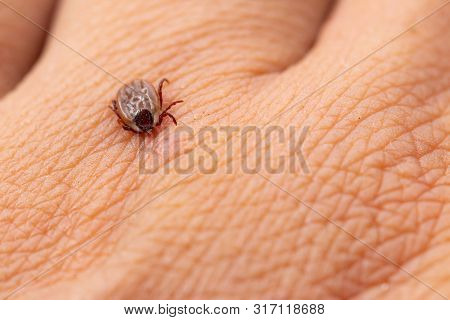 Tick Filled With Blood Sitting On Human Skin.