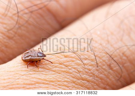 Tick Filled With Blood Sitting On Human Skin.