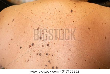 Woman Patient On Clinical Trials With Lot On Brown Nevus On Body Back