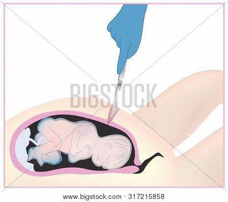 Caesarean Section Is Often Performed When A Vaginal Delivery Would Put The Baby Or Mother At Risk. T