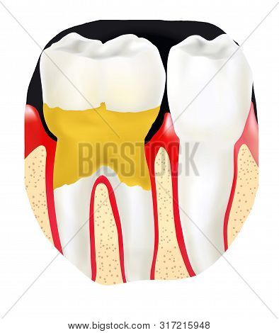 Dental Calculus Is The Calcified Plaque, Or Tartar, That Is Removed With A Dental Scalar During Regu