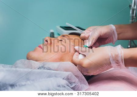 Close-up Of Procedure For Face Lifting Pdo Suture Operation, Face Lifting Surgery. Innovative Techni