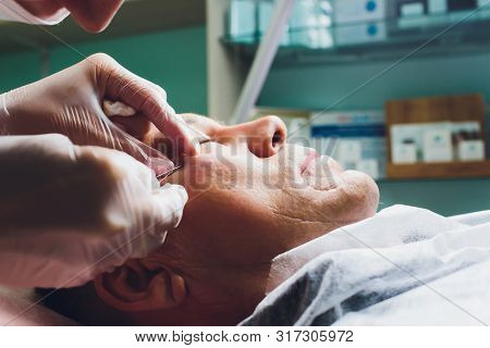 Close-up Of Procedure For Face Lifting Pdo Suture Operation, Face Lifting Surgery. Innovative Techni