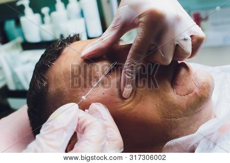 Close-up Of Procedure For Face Lifting Pdo Suture Operation, Face Lifting Surgery. Innovative Techni