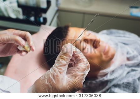 Close-up Of Procedure For Face Lifting Pdo Suture Operation, Face Lifting Surgery. Innovative Techni