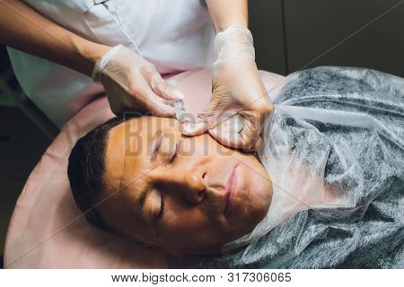 Close-up Of Procedure For Face Lifting Pdo Suture Operation, Face Lifting Surgery. Innovative Techni