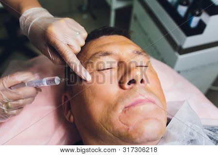 Close-up Of Procedure For Face Lifting Pdo Suture Operation, Face Lifting Surgery. Innovative Techni