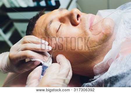 Close-up Of Procedure For Face Lifting Pdo Suture Operation, Face Lifting Surgery. Innovative Techni