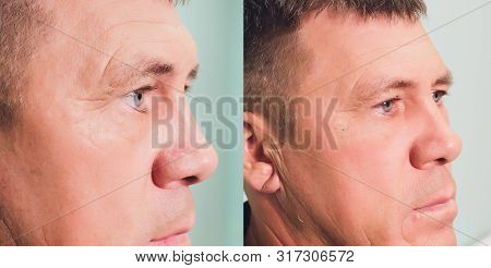 Close-up Of Procedure For Face Lifting Pdo Suture Operation, Face Lifting Surgery. Innovative Techni