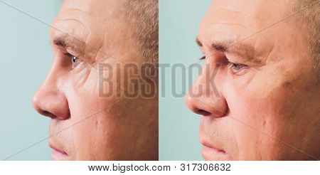 Close-up Of Procedure For Face Lifting Pdo Suture Operation, Face Lifting Surgery. Innovative Techni