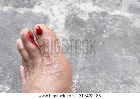 Fresh Wounds On The Floor Man Toe Nails On A Gray Old Cement Background.