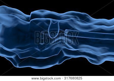 3d Rendering X-ray Endoscope Remove Colonic Polyp With Wire Loop