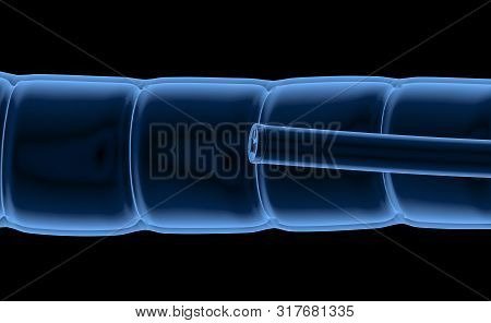 Colonoscopy Technology Concept With 3d Rendering X-ray Endoscope Inside Of Intestine