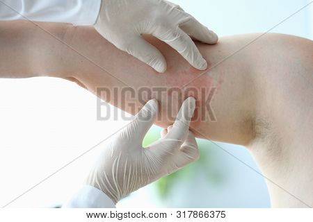 Male Doctor In White Protective Gloves Examines Patient With Skin Disease Against Office Background.